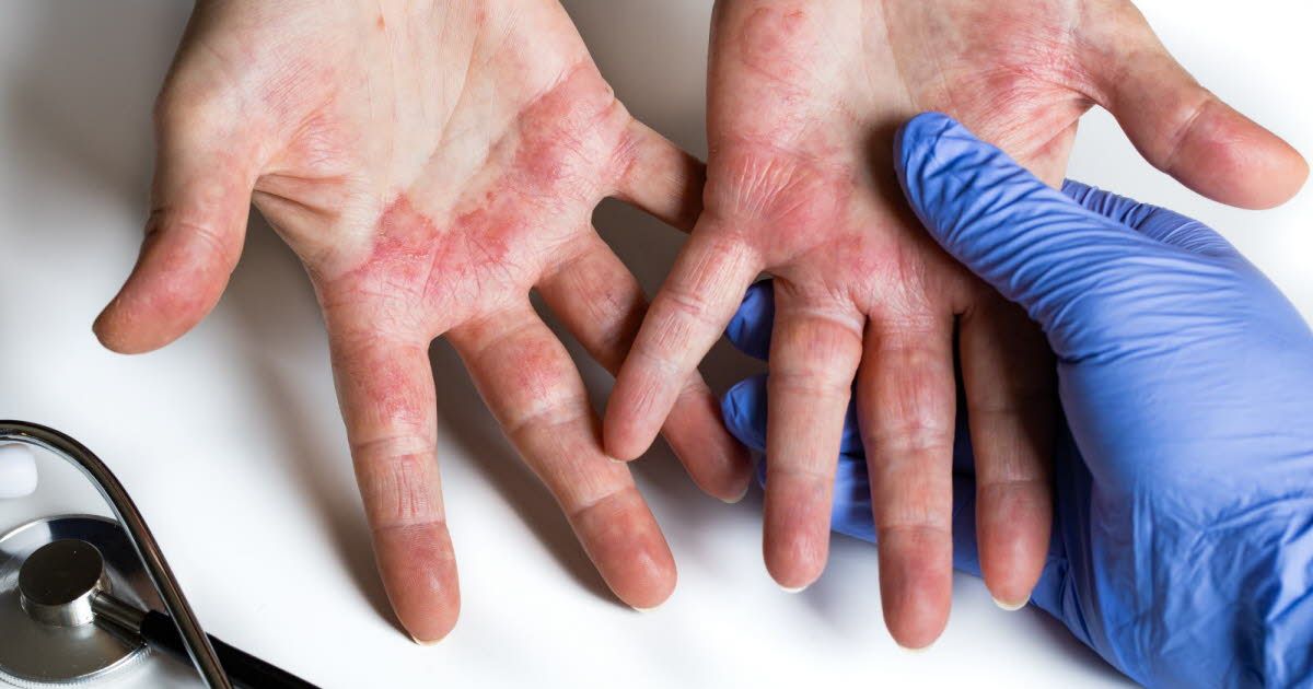 L'eczéma des mains : un combat quotidien méconnu